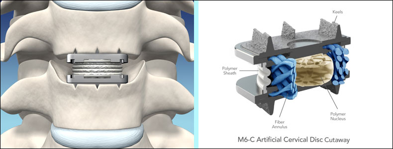 Bandscheibenvorfall an der Halswirbelsäule - Neurochirurg Darmstadt